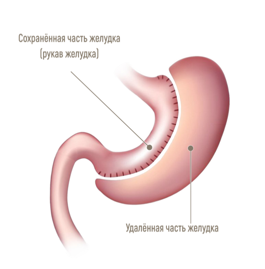Что такое резекция желудка для похудения. Лапароскопическая рукавная резекция желудка. Продольная резекция желудка схема. Продольная (рукавная) резекция желудка.